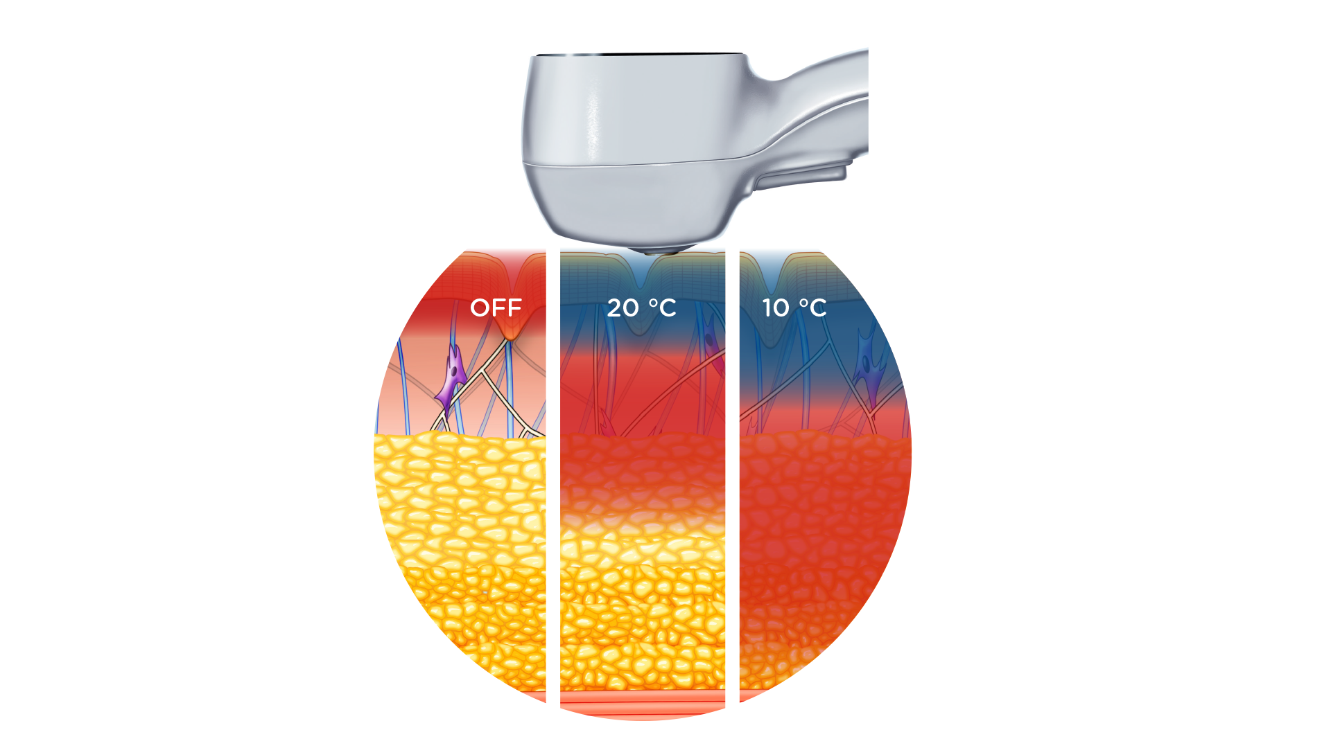 BTL Exilis hűtési technológia